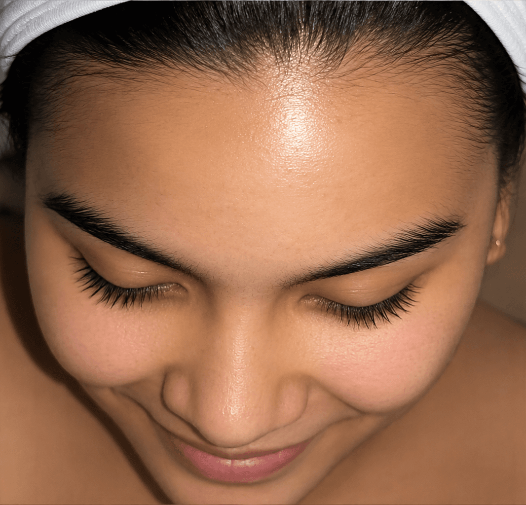 Acne Care Progress - after