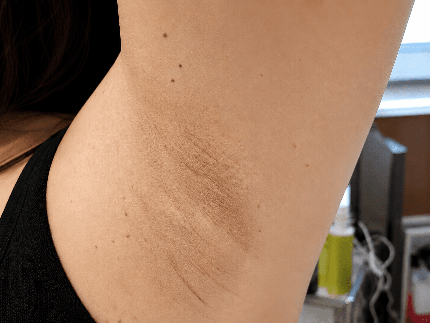 Skin Brightening Result - after