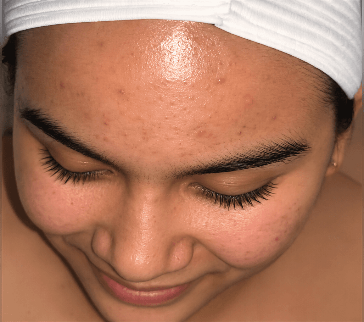 Acne Care Progress - before
