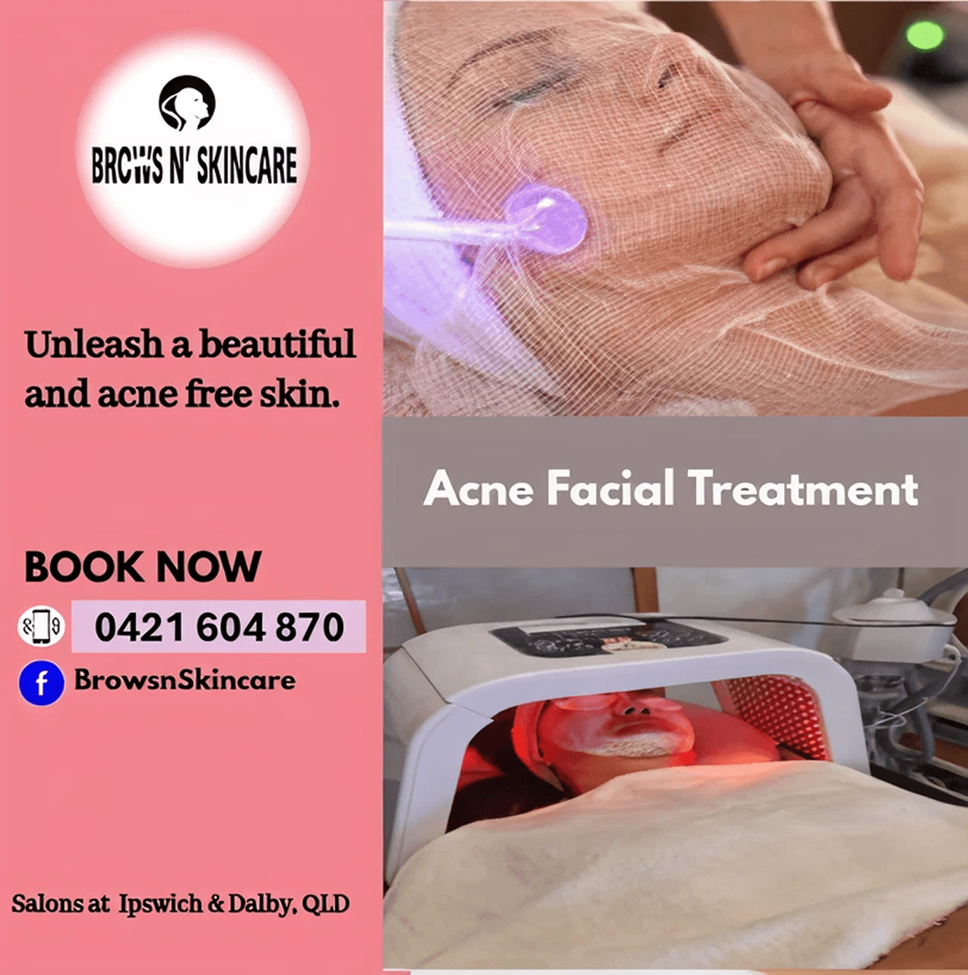 Acne Facial Treatment