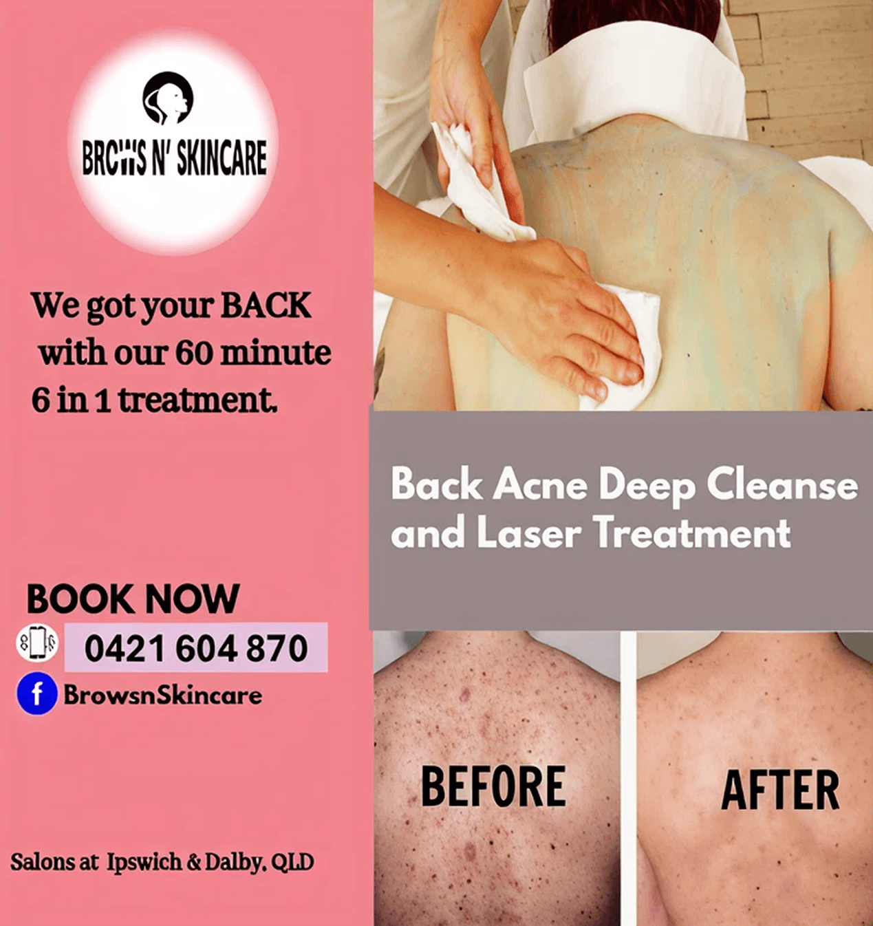 Back Acne Deep Cleanse and Laser Treatment