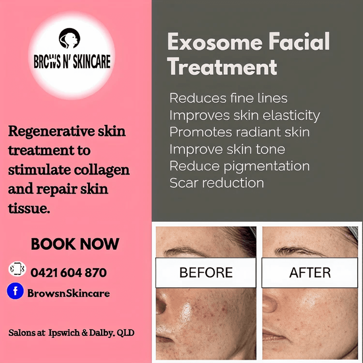 Exosome Facial Treatment