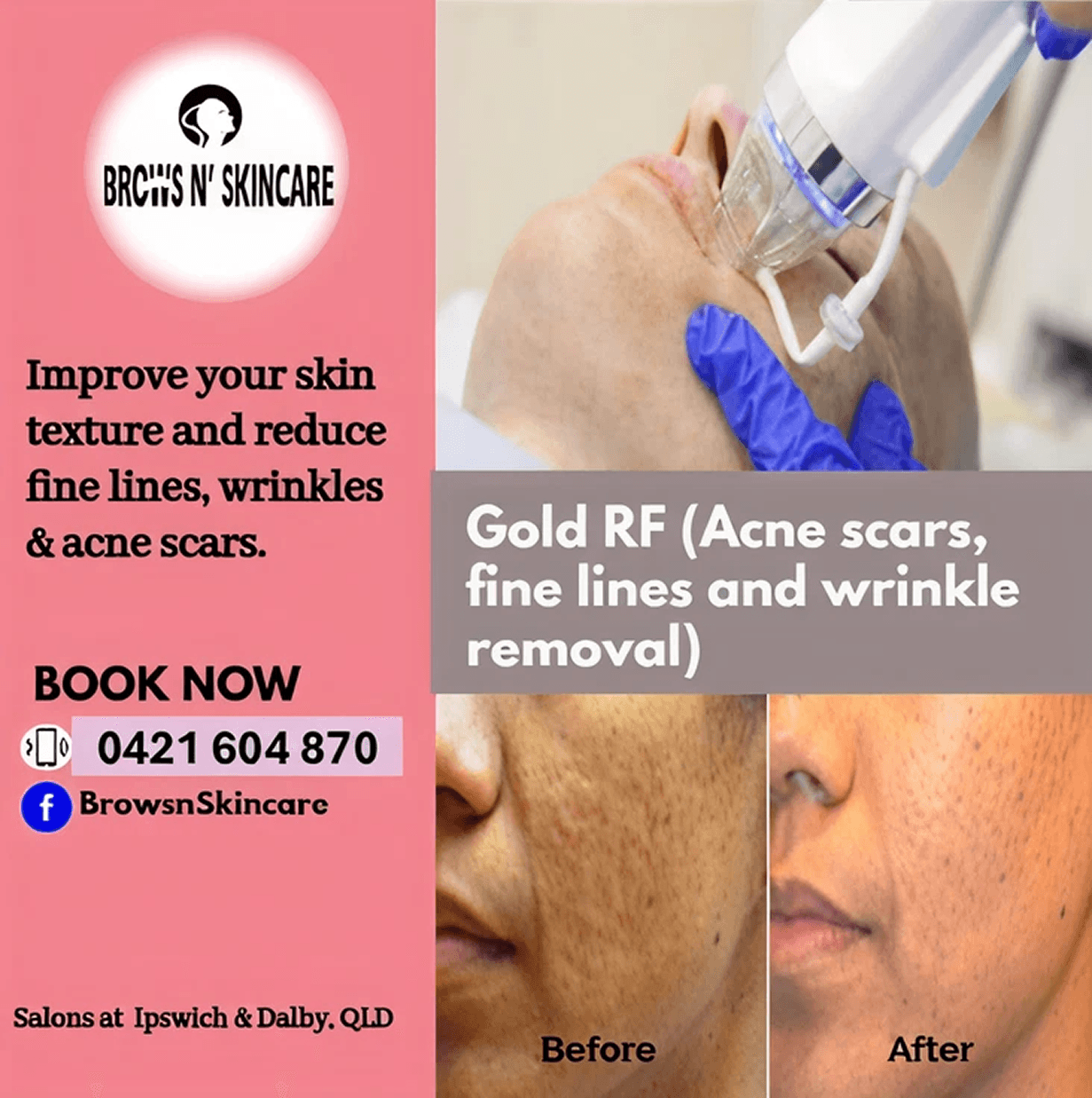 Gold RF (Acne scars, fine lines and wrinkle removal)