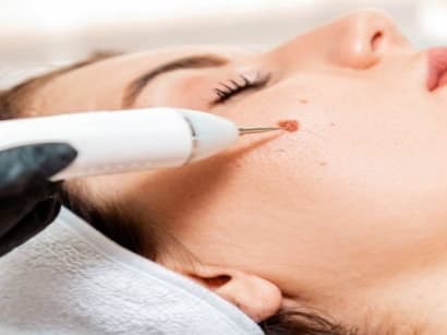 Warts and Skin Tag Removal visual