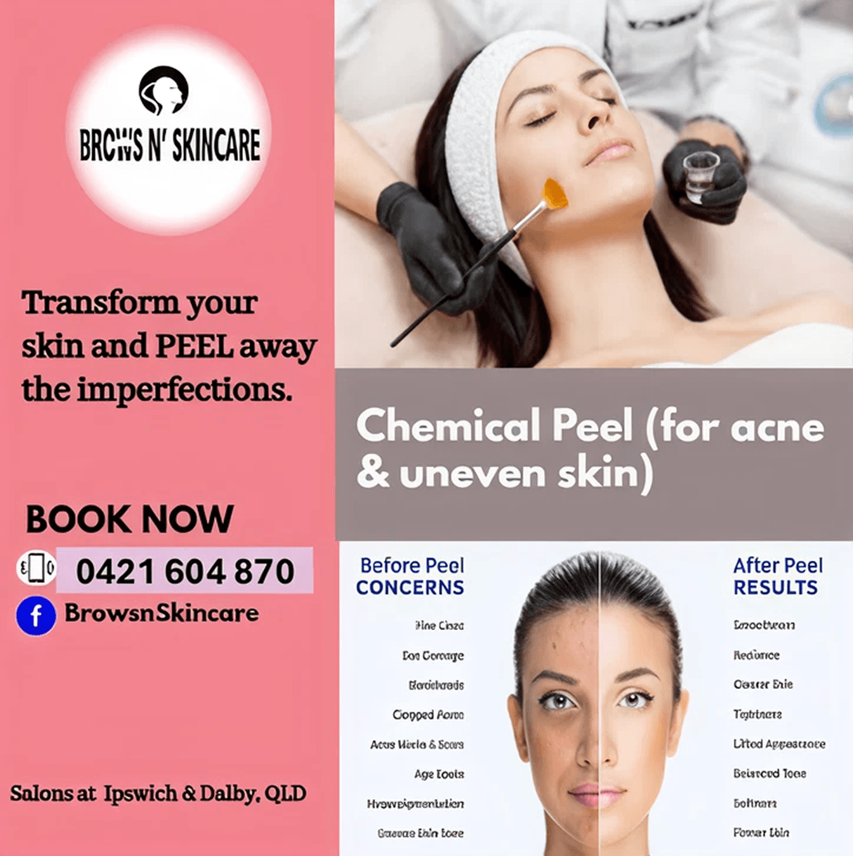 Chemical Peel (for acne & uneven skin)