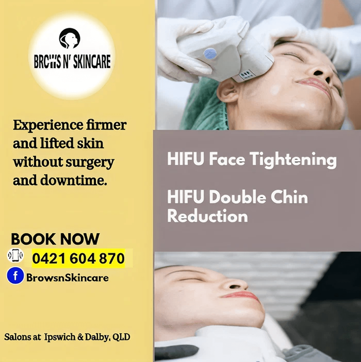 HIFU Face Tightening and HIFU Double Chin Reduction