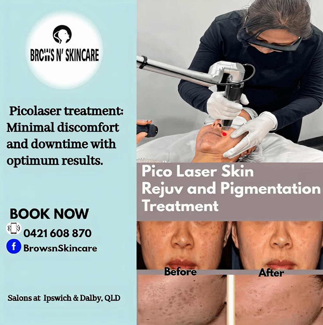 Pico Laser Skin Rejuv and Pigmentation Treatment