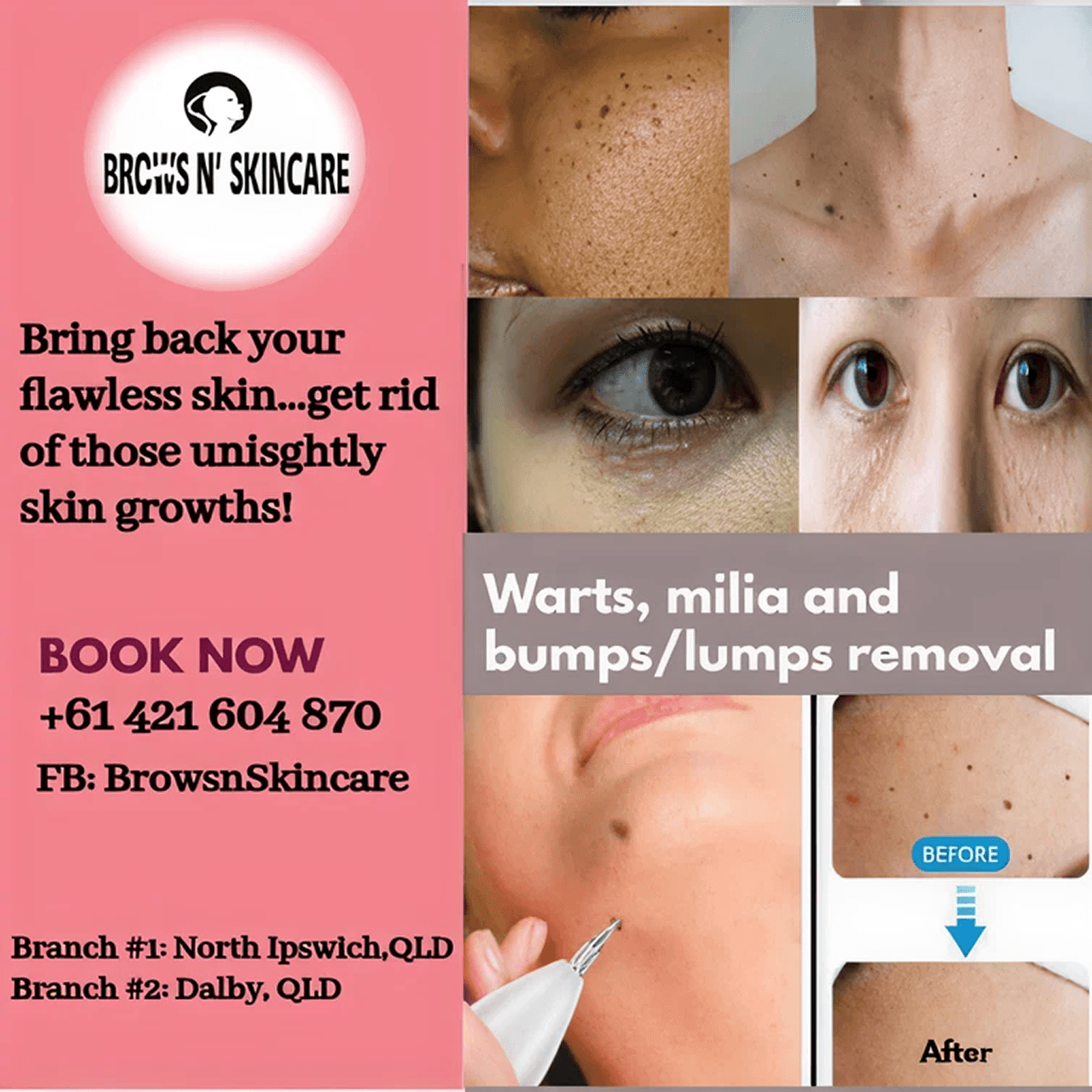 Warts, Milia, Bumps and Lumps Removal